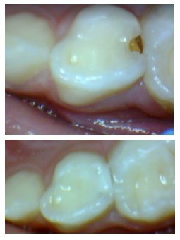 Close da câmera mostrando o começo de uma cárie entre os dentes